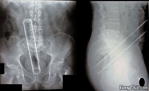 X rays